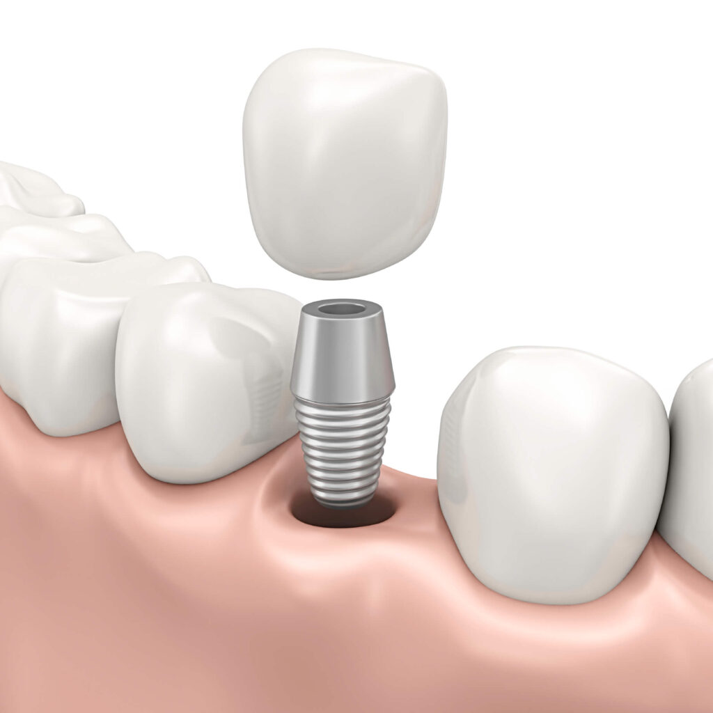 Benefits of Dental Implants at Chapel Hill Dental Arts