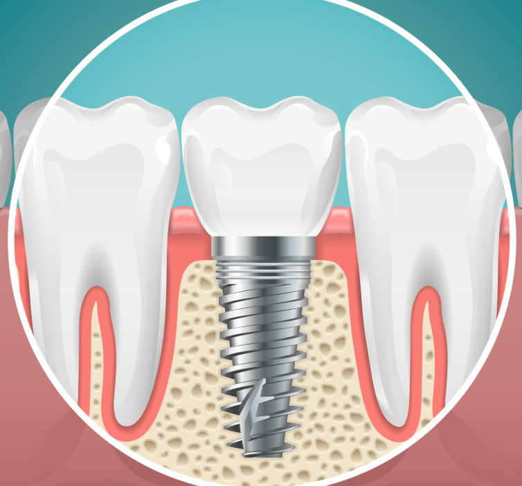 Illustrated cross section of a dental implant