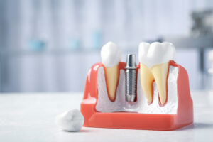 a mouth mold containing a single titanium implant post