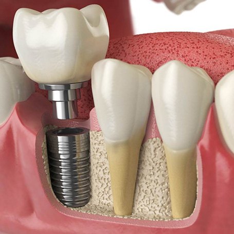 Illustration of dental implant in Middletown in lower jaw