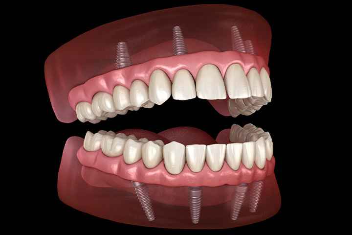 Illustration of teeth-in-a-day.