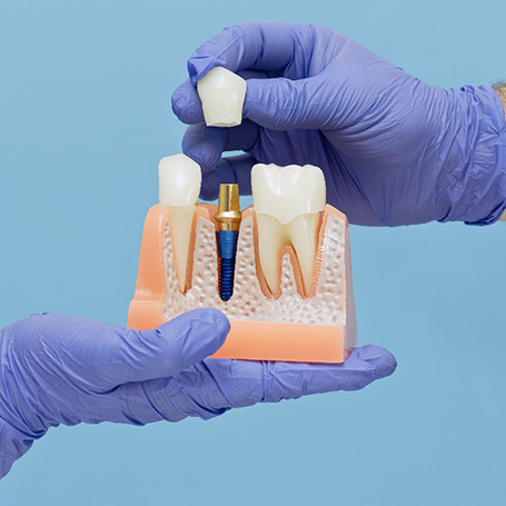 A dentist holding a dental implant model